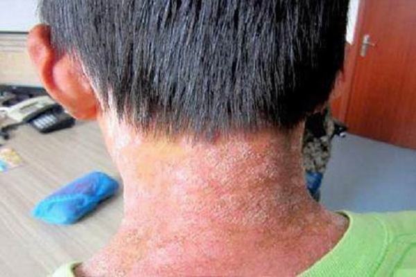 阜阳儿童银屑病医院